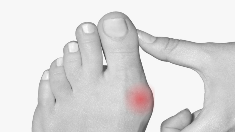 Behandla Hallux Valgus med hjälp av ortopediska skor och inlägg | Stinaa.J Officiell Butik